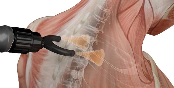 ondes de choc pour le dos