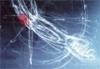 épicondylite et ondes de choc