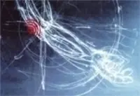 épicondylite et ondes de choc